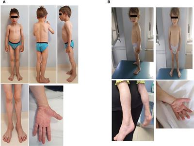A new mutation in the CAVIN1/PTRF gene in two siblings with congenital generalized lipodystrophy type 4: case reports and review of the literature